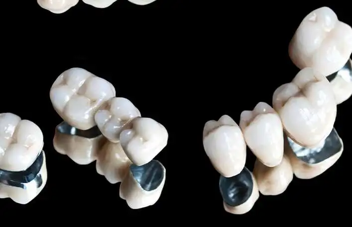 Metal - Qeramik Crown